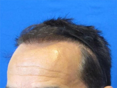 FUE Before and After Results